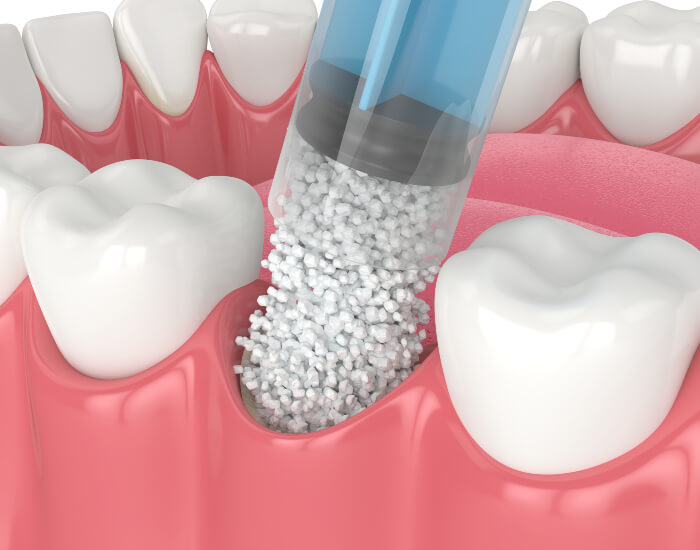 Bone Grafting